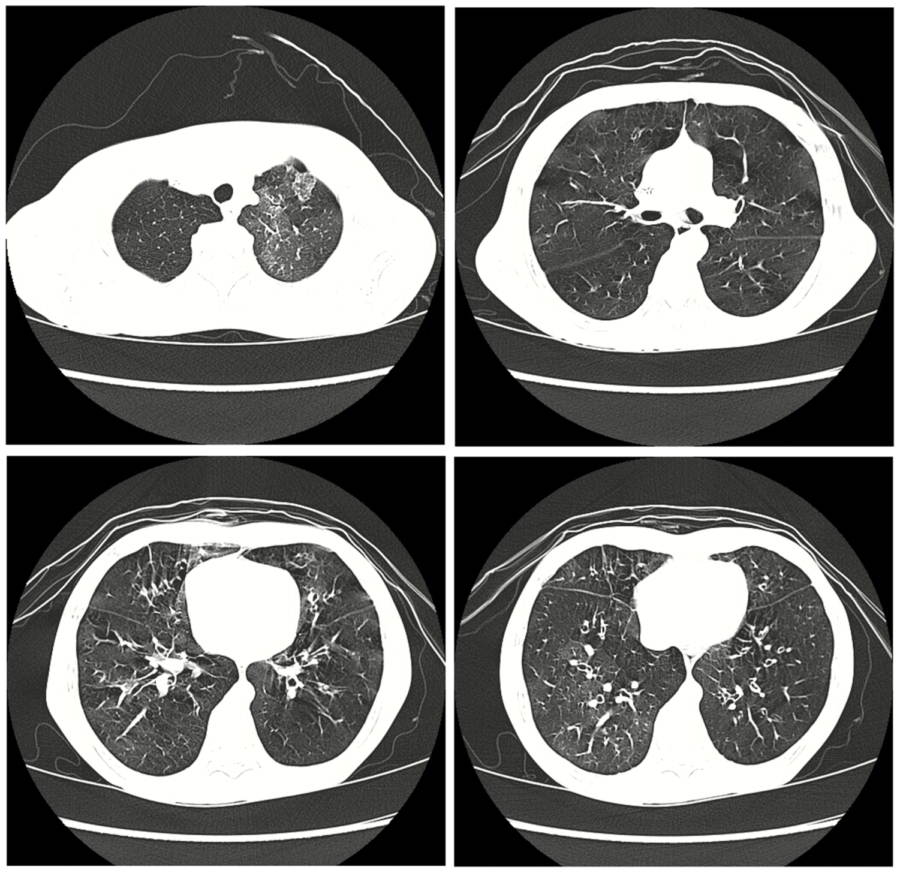 CT scan showing a hospital patient with bronchiolitis obliterans. Xie B-Q, Wang W, Zhang W-Q, Guo X-H, Yang M-F, Wang L, et al. (2014) Ventilation/Perfusion Scintigraphy in Children with Post-Infectious Bronchiolitis Obliterans: A Pilot Study. PLoS ONE 9(5): e98381. https://doi.org/10.1371/journal.pone.0098381state